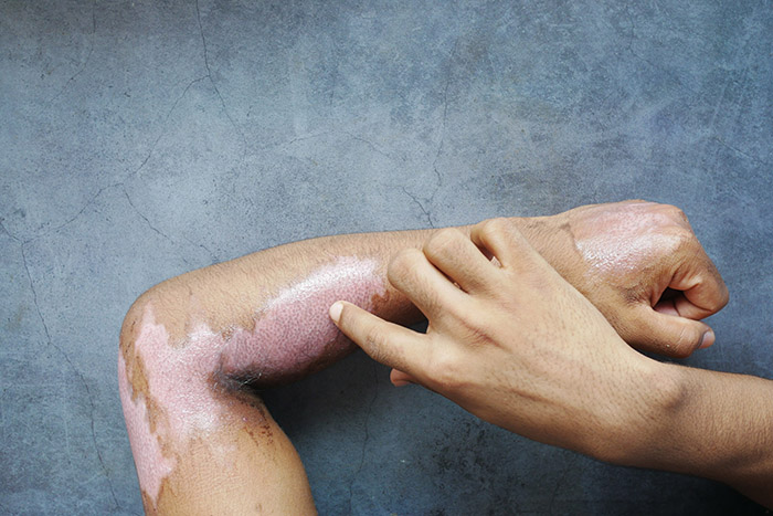 burn victim lawyer los angeles burn victim lawyer los angeles